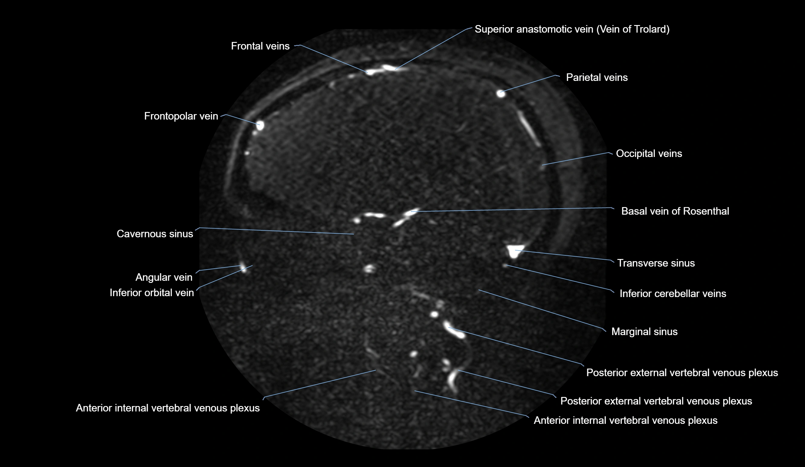 MRV brain sagittal anatomy 3T MRI labelledimages -00051.webp